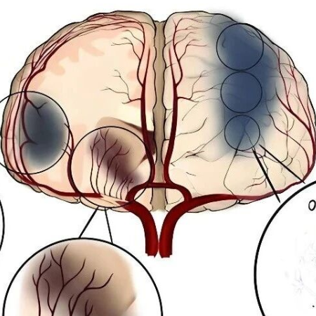 解码缺血性卒中代谢重编程！CDD｜复旦大学许树茂/王念宏：从“糖酵解风暴”到“脂质紊乱”的系统调控与