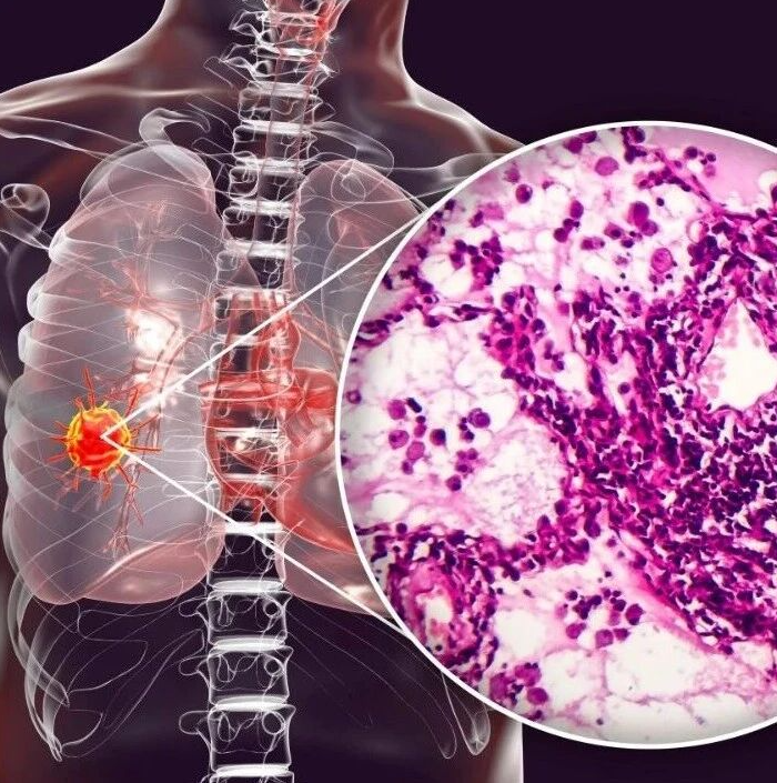 发布肺腺癌“千人基因组计划”成果！Cell Res｜复旦大学金力院士/陈海泉/石乐明：绘制肺腺癌进展