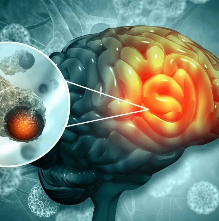 关键驱动因子与预后标志物！CDD｜复旦大学李继喜：首次确立程序性坏死与胶质瘤恶性程度的强关联，为治疗
