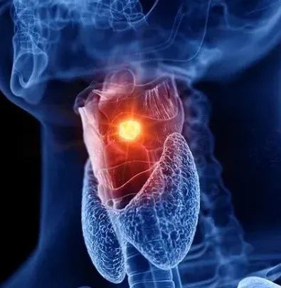 治疗更精准-预后更可期！Radiology｜复旦大学黄新生：AI辅助工具助力喉癌、下咽癌淋巴结包膜外