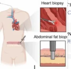 架起“结构生物学与临床诊断”间的桥梁！PNAS｜复旦大学周京敏：合作开发基于病理聚集体的轻链淀粉样变