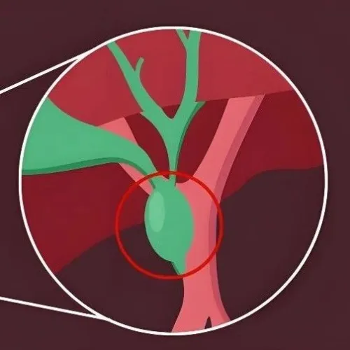 破解“胆道闭锁”致病迷雾！SCLS｜复旦大学郑珊：绘制全球最大规模家系多组学图谱，首次锁定“细胞黏附