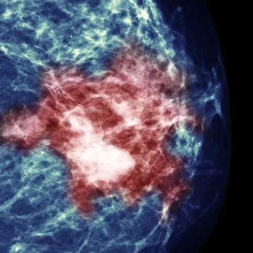 “靶向-放疗-免疫”三联疗法！Cancer Res｜复旦大学刘静/俞晓立：合作揭示SDC1⁺ CAF