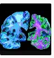 “阿尔茨海默病”诊断新成果！Brain｜复旦大学郁金泰/赵倩华/崔梅/左传涛：发现Tau PET在A